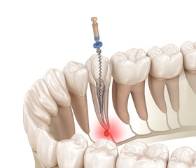 endodontics procedures